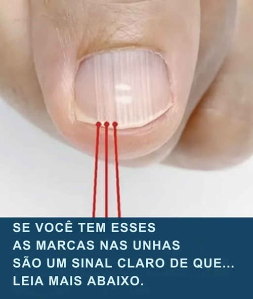 Listras Misteriosas nas Unhas: Um Sinal de Alerta Para a Sua Saúde?