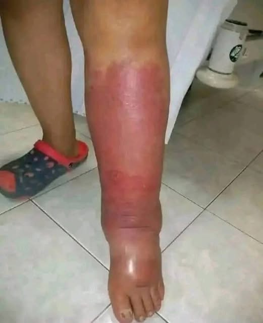 Os Primeiros Sintomas da Inflamação: Como Reconhecê-los e Tratá-los Naturalmente