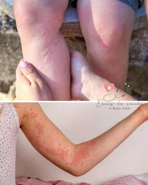 Alergia Emocional: Fique Atento a Estes Sintomas e Procure Tratamento